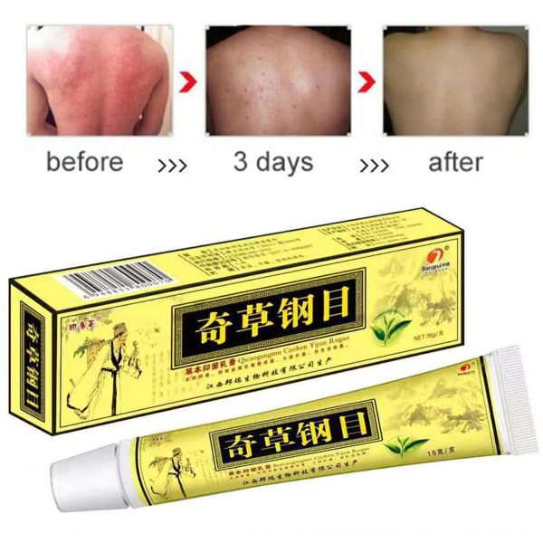 Advanced Body Psoriasis Cream For Dermatitis Eczema Skin Rash Natural Treatment Pruritus Skin Care Psoriasis Ointment Herbal Creams 15g/pc
